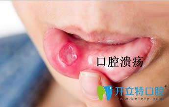 開(kāi)立特引起復(fù)發(fā)性口腔潰瘍?cè)蚴鞘裁? border=