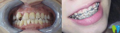 北京誠(chéng)之康口腔正畸怎么樣？來(lái)看對(duì)比圖