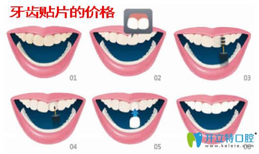 牙齒貼片的價格