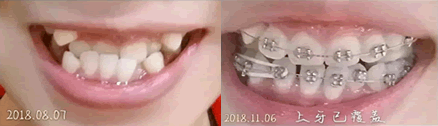 誠(chéng)之康口腔周春醫(yī)生做牙齒矯正的三個(gè)月對(duì)比圖