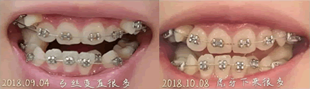 我在誠(chéng)之康口腔牙齒矯正一個(gè)月效果圖