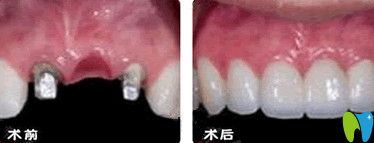 北京誠之康口腔種植牙前后對(duì)比圖