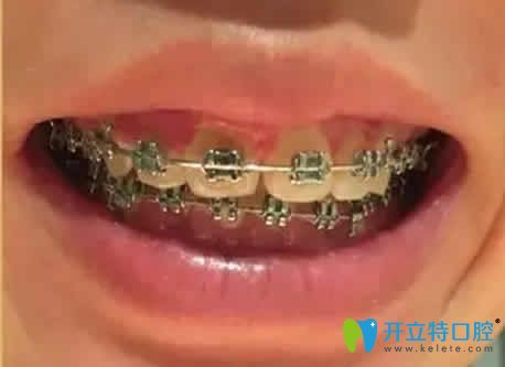 我在廣州偉聯(lián)口腔做自鎖托槽矯正第10個月照片