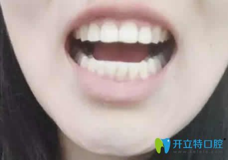 我在廣州偉聯(lián)口腔做正畸14個月效果