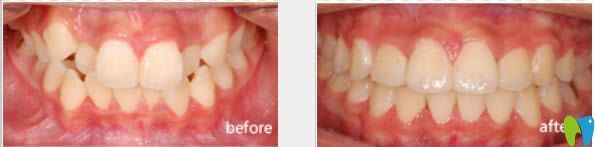廈門峰煜牙齒擁擠不齊矯正案例