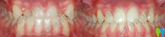 衡陽協(xié)合口腔陽望春院長牙齒矯正前后對比圖
