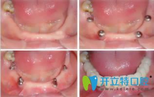 杭州植得口腔半口牙種植效果對(duì)比圖