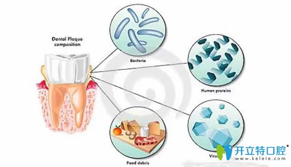 牙菌斑形成圖示