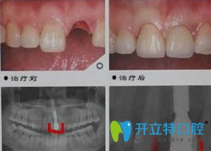 杭州植得口腔單顆牙種植效果對(duì)比圖