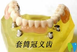 詳解什么是套筒冠義齒,以及套筒冠假牙的優(yōu)缺點(diǎn)和制作過程