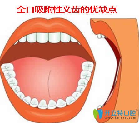全口吸附性義齒的優(yōu)缺點(diǎn)