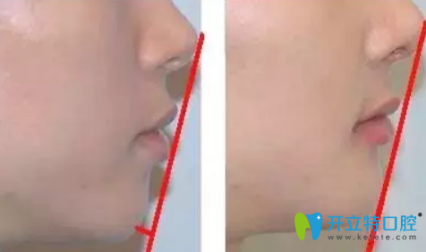 簡單的判斷齙牙是牙性還是骨性的方法