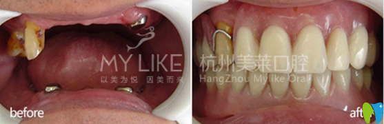 美萊口腔老年活動(dòng)義齒修復(fù)缺牙牙齒案例對(duì)比圖