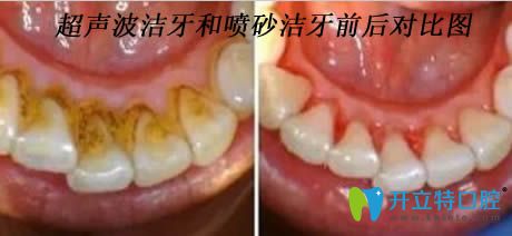 開立特口腔解答潔牙后注意事項