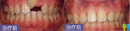 深圳烤瓷牙哪家好？鵬程口腔牙齒修復(fù)案例來(lái)嘍