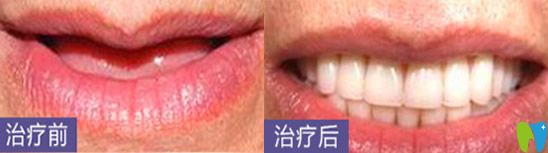 深圳哪家種植牙好？看深圳鵬程口腔種植牙案例