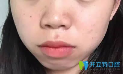 在廈門(mén)<!--<i data=20240703-sp></i>-->口腔剛戴牙套的照片