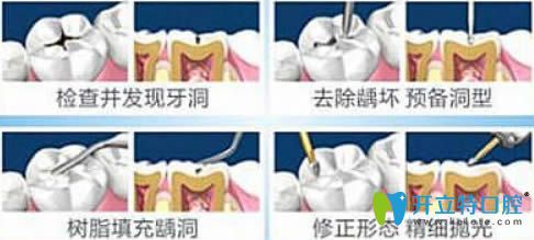開立特口腔網(wǎng)兒童補牙過程圖解