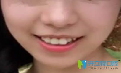 佩戴正雅隱形牙套3個(gè)月留照