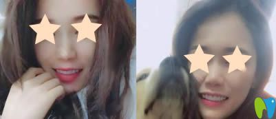 重慶眾植博仕口腔超薄牙貼面術(shù)后一月照