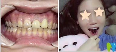 重慶眾植博仕口腔超薄瓷貼面效果對(duì)比圖