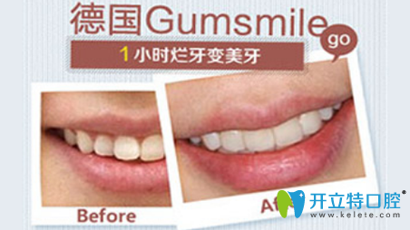 屬于福州格萊美德國Gumsmile修復牙齒案例前后獨對比照片
