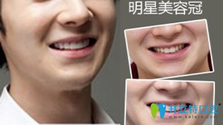 在福州格萊美口腔做明星美容冠修復牙齒案例