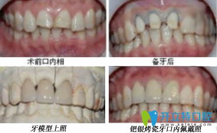 銀鈀烤瓷牙圖片
