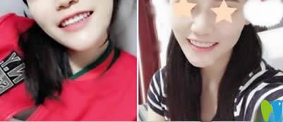 重慶眾植博仕口腔牙貼面美白后照片