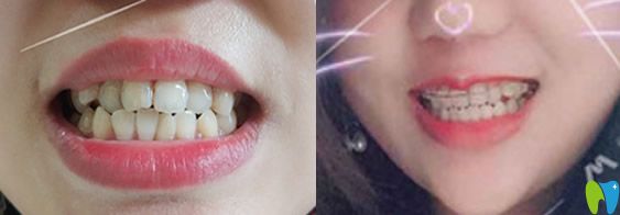在北京溪美康口腔做牙齒矯正后效果對(duì)比
