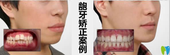 貴陽(yáng)華美口腔齙牙矯正臉型變化圖