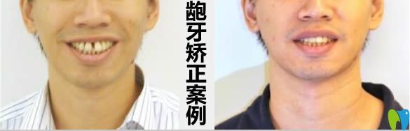 齙牙矯正案例及前后對(duì)比效果