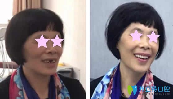 老媽在重慶華諾世口腔做種植牙前后對比照片