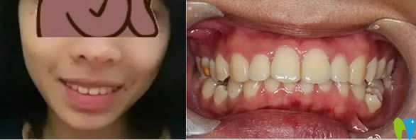 推薦大家去貴陽(yáng)華美口腔做牙齒矯正 我覺得價(jià)格/效果都滿意