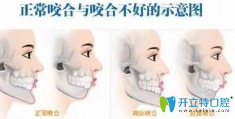 半口或局部牙齒矯正可能會導致咬合不好示意圖