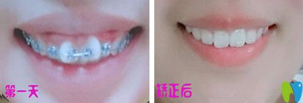 牙齒只有一兩顆不齊可以做半口矯正嗎？來看北京中諾口腔半口牙矯正真人案例