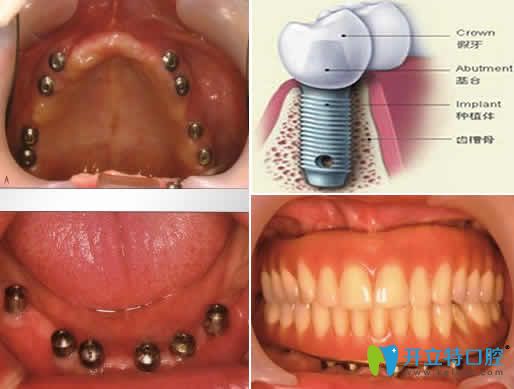 成都德頓齒科熊江全口種植牙效果圖 成都德頓齒科熊江全口種植牙效果圖