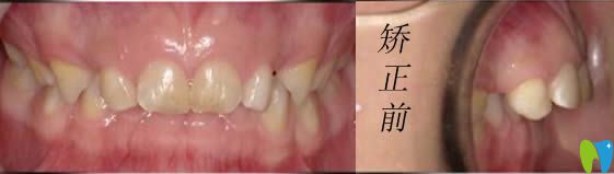 小孩在<!--<i data=20240703-sp></i>-->恒愿齒科做牙齒矯正前的照片 小孩在<!--<i data=20240703-sp></i>-->恒愿齒科做牙齒矯正前的照片