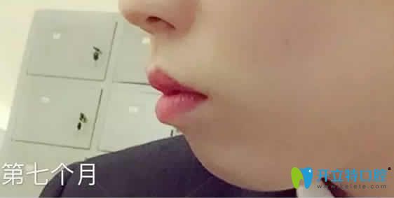 我在成都德頓齒科做牙齒矯正第7個月照片