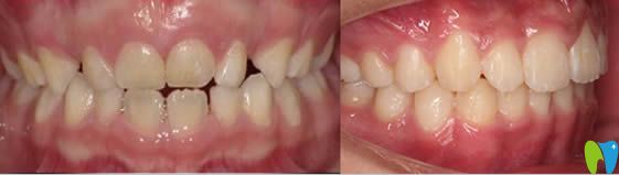 <!--<i data=20240703-sp></i>-->恒愿口腔兒童牙齒正畸完成照 <!--<i data=20240703-sp></i>-->恒愿口腔兒童牙齒正畸完成照