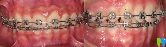 <!--<i data=20240703-sp></i>-->恒愿齒科牙齒矯正術(shù)中照 <!--<i data=20240703-sp></i>-->恒愿齒科牙齒矯正術(shù)中照