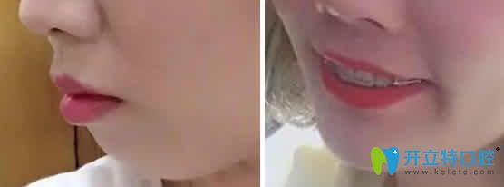 我在成都德頓齒科做陶瓷托槽矯正第15個月照片