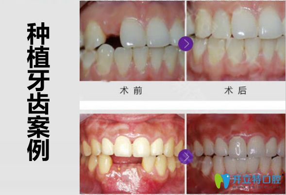 廣州壹加壹口腔鄭育亮醫(yī)生多顆牙缺失種植案例
