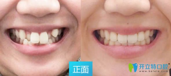 28歲顧客隱適美隱形矯正前對比效果