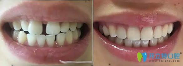 牙齒樹脂貼面修補(bǔ)牙縫案例對(duì)比圖
