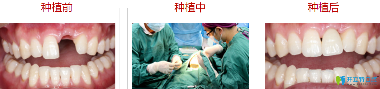 深圳哪里種牙比較好？來看格倫菲爾種植牙案例