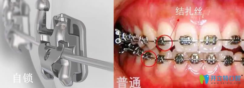自鎖托槽矯正一萬(wàn)貴嗎？自鎖托槽比金屬托槽好在哪里？