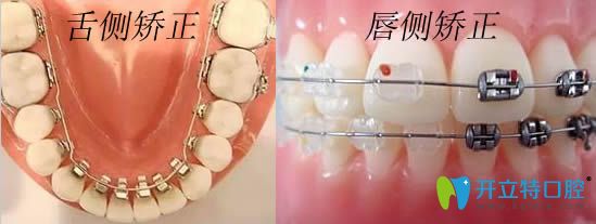 專業(yè)解答:唇側和舌側隱形矯正哪個好?并附上價格和效果圖