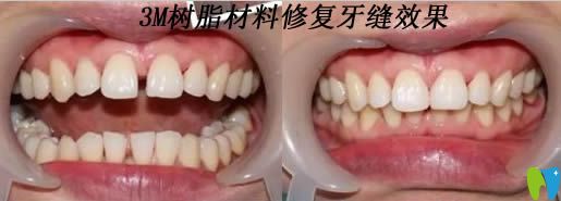 美國(guó)3M樹(shù)脂材料修復(fù)牙縫效果對(duì)比圖