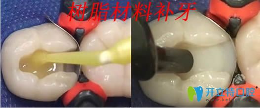 樹(shù)脂材料補(bǔ)牙過(guò)程圖